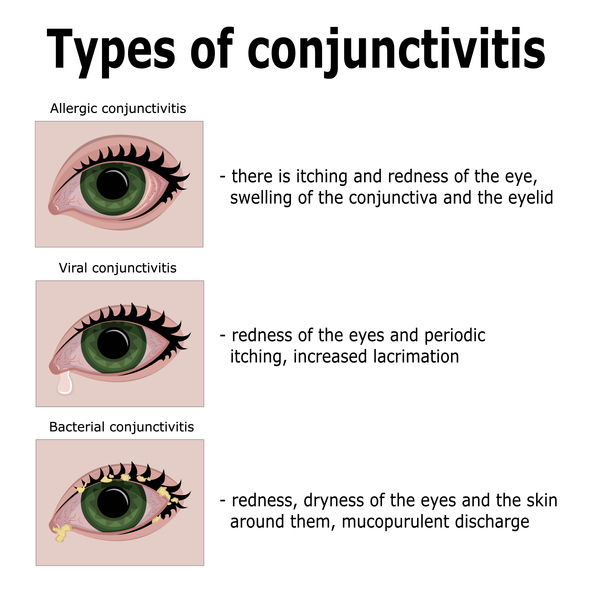 Les types de conjonctivite