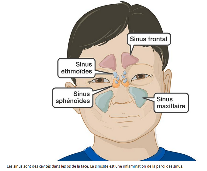 Schémas indiquant la localisation des sinus.